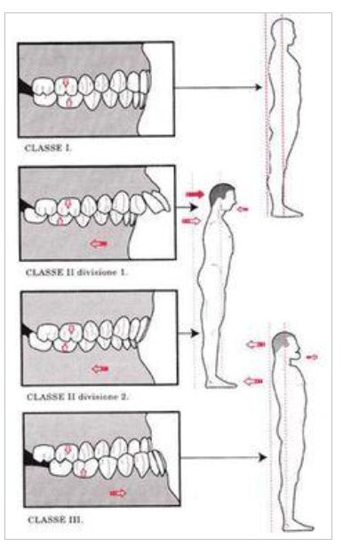 Figura 13. Classificação de ANGLE. Fonte: Biosotto-Gonzalez, 2005.