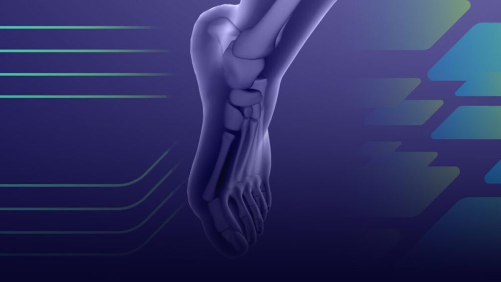 Fasciopatia_Plantar