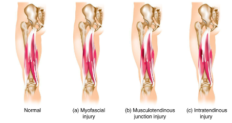 Lesões musculares