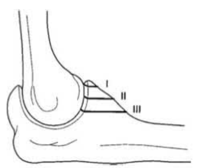 Figura 12. Classificação Regan e Morrey. Fonte: THAYER et al., 2018.