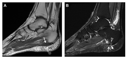 Figura 12: (A) Ressonância Magnética, plano sagital em T1, setas apontam para origem da banda central da fáscia com intensidade moderada de sinal. (B) Sagital em T2, setas mostram aumento heterogênio de sinal envolvendo a banda central com foco de edema ósseo no calcâneo. Fonte: Latt LD. et al., 2020.