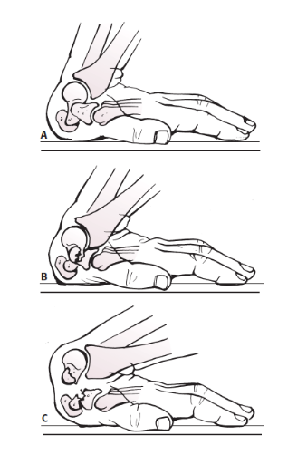 Figura 12: O esquema acima demonstra a progressão para fratura do escafoide durante uma lesão por hiperextensão do punho. O polo proximal do escafóide fica preso entre o rádio e os ligamentos palmares extrínsecos tensos, com a força concentrada na cintura do escafoide levando à fratura. Fonte: Rockwood and Green’s. Fractures in adults. 8ª edição.