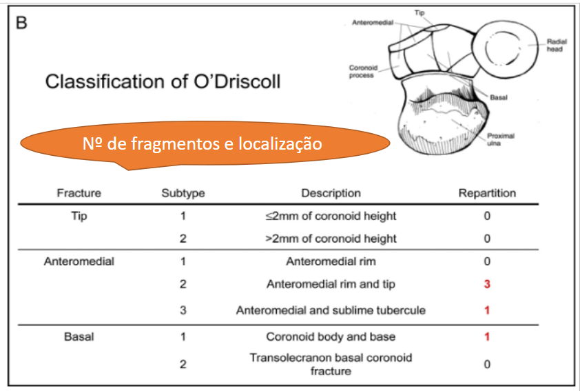 Figura 13. Classificação O’Driscoll. Fonte: THAYER et al., 2018 e https://core.ac.uk/reader/81108582