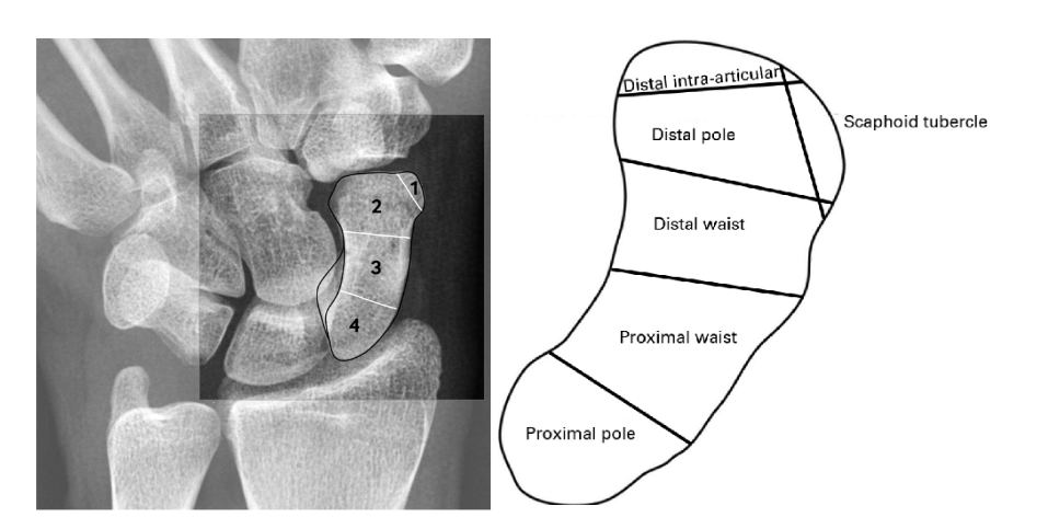 Figura 13: Diagrama do escafóide identificando o plano de fraturas. Fonte:K. GARALA, N. A. TAUB, J. J. DIAS. THE EPIDEMIOLOGY OF FRACTURES OF THE SCAPHOID. THE BONE & JOINT JOURNALVOL. 98-B, No. 5, MAY 2016