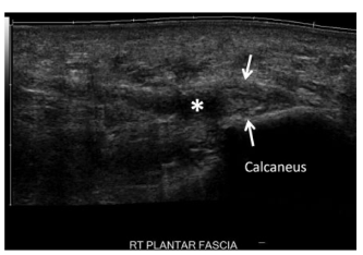 Figura 14: Ulrassonografia mostrando espessamento da fáscia plantar das bandas central e medial, medindo mais de 6mm e local (asterisco) de hipoecogenicidade no aspecto medial da banda central. Fonte: Latt LD. et al., 2020.