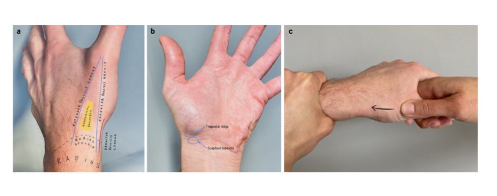 Figura 14: Marcas superficiais de (a) tabaqueira anatômica (triângulo amarelo) e (b) o tubérculo do escafóide. A crista do trapézio também é indicada para destacar a proximidade das duas estruturas anatômicas. (c) O teste de compressão longitudinal do polegar.Fonte:FOWLER, J. R.; HUGHES, T. B. Scaphoid Fractures. Clinics in Sports Medicine, v. 34, n. 1, p. 37–50, jan. 2015.