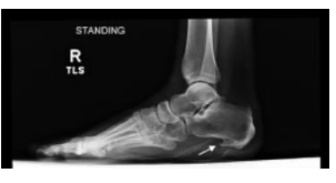 Figura 15: Radiografia lateral com descarga de peso mostrando grande espícula óssea no osso calcâneo. Fonte: Latt LD. et al., 2020.