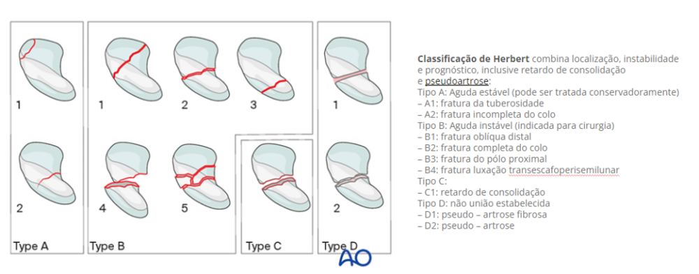 Figura 15: Classificação de Herbert. Fonte: https://surgeryreference.aofoundation.org/orthopedic-trauma/adult-trauma/carpal-bones/further-reading/classifications-for-fractures-of-carpal-bones.