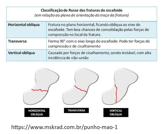 Figura 16: Classificação de Russe. Fonte: Sabbagh et al, 2019; https://www.mskrad.com.br/punho-mao-1