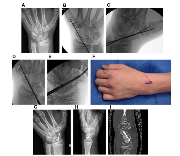 Figura 17: Procedimento cirúrgico. Um caso de fratura na cintura do escafoide tratada com uma abordagem percutânea dorsal em um jogador de futebol de 16 anos. (A) Visão desviada do escafoide para a ulna, mostrando uma fratura minimamente deslocada no escafoide esquerdo. (B) Colocação central do fio de Kirchner (K-wire) é crucial para o posicionamento central do parafuso. (C) Um segundo K-wire é colocado como um fio anti-rotação, antes do alargamento do escafoide. (D) A alargamento é realizado com auxílio do fluoroscópio para evitar perfuração excessiva. (E) Um parafuso de compressão foi colocado através do local da fratura. Uma visão oblíqua é útil para evitar o posicionamento do parafuso na articulação escafo-trapezoide-trapezoide. (F) Aparência da mão ao final do procedimento. A abordagem mini-open permite a proteção dos tendões extensor longo do polegar (EPL) e extensor radial curto do carpo (ECRB) durante a colocação do parafuso. (G, H) Radiografias anteroposterior (AP) e lateral mostrando fratura cicatrizada e bom alinhamento carpiano. (I) Tomografia computadorizada final mostrando cicatrização completa e um parafuso bem posicionado em 8 semanas Fonte: Sabbagh et al, 2019.