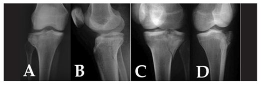 Figura 1. Projeções radiográficas para diagnóstico de fratura do planalto tibial. A: anteroposterior; B: Perfil; C: Oblíqua interna; D: oblíqua externa. Observar como o entendimento do caso é facilitado pelas incidências oblíquas. Fonte: kfuri Jr., 2009.