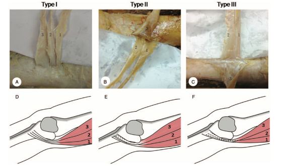 Síndrome da dor do trocânter maior Imagem 2. Avaliação da força isométrica de abdutores de quadril. Fonte: Teixeira et al., 2021.