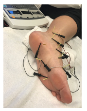 Figura 24: Dry needling associado à eletroestimulação. Fonte: Dunning J et al, 2018.