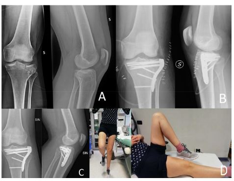 Figura 3. Fratura de platô tibial Schatzker II, tratado por RAFI com protocolo de descarga de peso precoce, 20 kg pelos 7 primeiros dias e depois de acordo com o tolerado. (A) RX pré-operatório, (B) RX pós – operatório, (C) RX de 5 semanas, (D) resultados clínicos em 5 semanas. Fonte: Canton et al. Journal of Orthopaedic Surgery and Research (2022) 17:261.