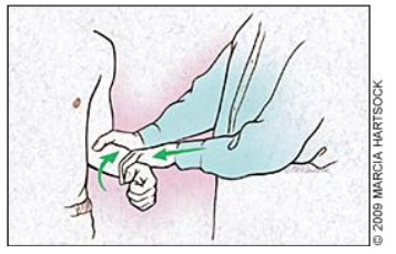 Figura 3. Yergason test. Fonte: Churgay CA. Diagnosis and treatment of biceps tendinitis and tendinosis. Am Fam Physician. 2009 Sep 1;80(5):470-6. PMID: 19725488.