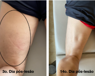 Lesões musculares