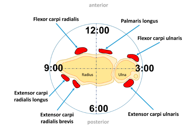 Figura 6_Fratura de Escafóide