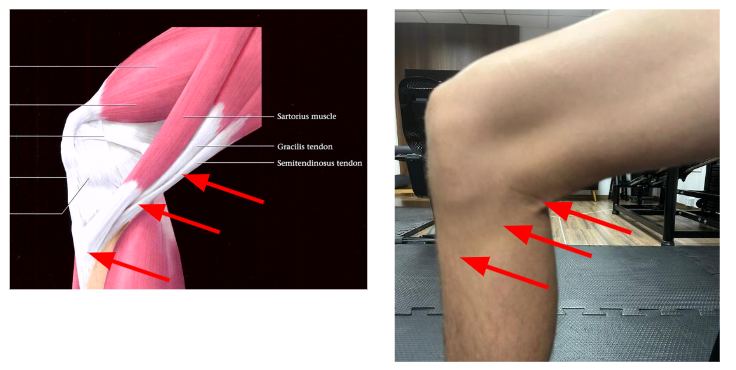 Figura 7: Local para a palpação da pata de ganso e seus músculos, bem como toda a região medial do joelho. Fonte: Diagnostic and surgical imaging anatomy. Musculoskeletal / B.J. Manaster et al.; managing editor, R. Kent Sanders. - 1st ed.