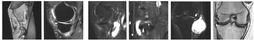 Figura 9: Cortes sagitais e frontais do joelho, demonstrando a burso-tendinopatia da pata de ganso. Fonte: Diagnostic imaging, orthopaedics / David W. Stoller, Phillip F.J. Tirman, Miriam A. Bredella; Salvador Beltran, medical illustrator- 1st ed
