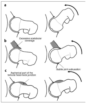 Síndrome do Impacto Femoroacetabular_Figura 2