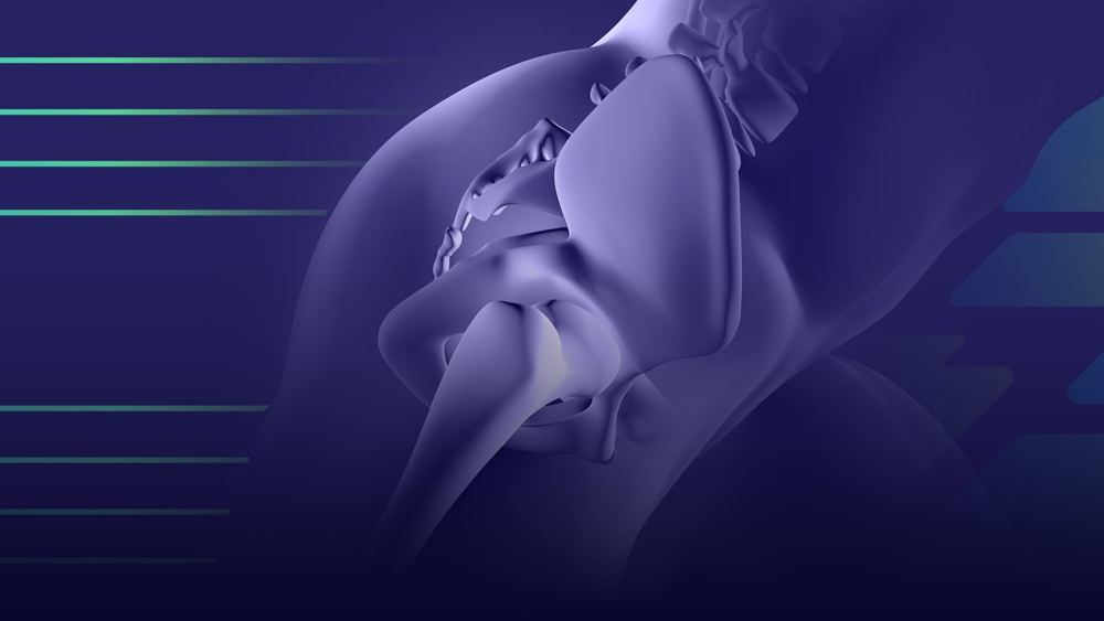 Síndrome do Impacto Femoroacetabular
