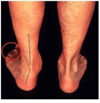 Figura 11: Teste de “Too Many Toes”. Fonte: https://www.pioneerpodiatry.com.au/acquired-adult-flat-foot