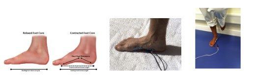 Figura 18: Fortalecimento da musculatura intrínseca do pé com o exercício Doming, também conhecido como short-foot exercise. Pode ser associado à eletroestimulação neuromuscular. Fonte: McKeon PO et al. Freeing the foot: Integrating the Foot Core System into Rehabilitation for Lower Extremity Injuries. Clin Sports Med 34 (2015) 347–361