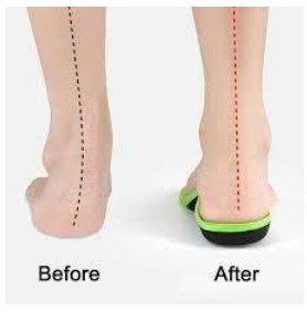 Figura 24: Palmilhas para pacientes com TTP. Fonte: https://www.walmart.com/ip/Plantar-Fasciitis-Orthotic-Shoe-Inserts-Athletic-Running-Insoles-Women-Men-Arch-Support-Gel-Comfort-Insoles-Relieve-Fallen-Arch-Flat-Feet-metatarsalg/375028202