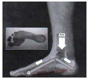 Figura 5: Dissipação de forças no ALM com descarga de peso. Fonte: Neumann D. A. Cinesiologia do aparelho musculoesquelético: fundamentos para a reabilitação física. 2006, Ed. Guanabara koogan, Rio de Janeiro