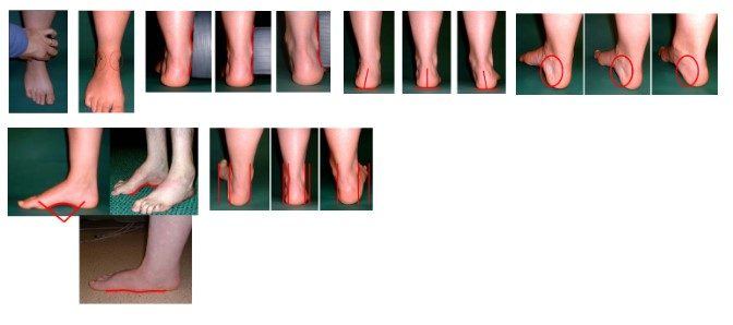 Figura 7: Os 6 itens que compõem o FPI-6. Fonte: Martinez BR, De Oliveira JC, Vieira KVSG & Yi LC (2019): Translation, Cross-cultural Adaptation and Reliability of The Foot Posture Index (FPI-6) - Brazilian Version, Physiotherapy Theory and Practice.