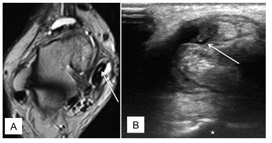 Figura 16: (A) Imagem de RNM mostrando líquido intratendíneo com lesão parcial do tendão tibial posterior; (B) Imagem de Ultrassom mostrando lesão parcial do tendão tibial posterior. Fonte: Arnoldner MA. et al. Imaging of posterior tibial tendon dysfunction—Comparison of high-resolution ultrasound and 3 T MRI. European Journal of Radiology 84 (2015) 1777–1781.